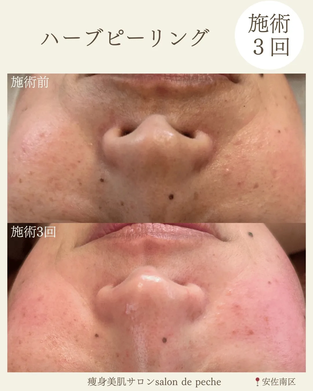 ハーブピーリング3回の変化【広島市/ニキビ/毛穴】