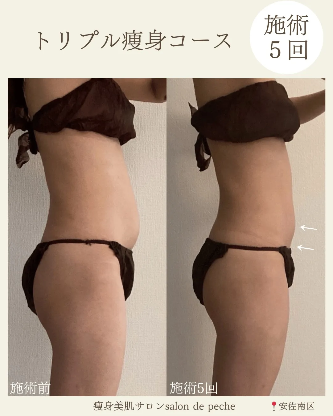 トリプル痩身コース5回の変化【広島市/ダイエット/オイルマッ...